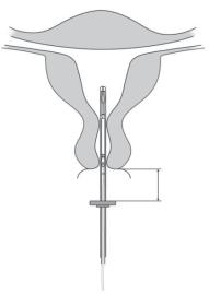 4. Hold skyderen i den yderste stilling, og før indføreren gennem cervix indtil markøren er ca. 1.5-2.0 cm fra cervix (fig. 4). 1,5-2,0 cm Vigtigt! Tving ikke indføreren igennem.