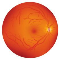 Figur 2 Måling af nervetrådslaget omkring synsnervehovedet (papillen) A B Lys Glaslegeme Nervetrådslag Sanseceller Pigmentceller Membran Årehinde Tværsnit af nethinden Gule plet (makula)