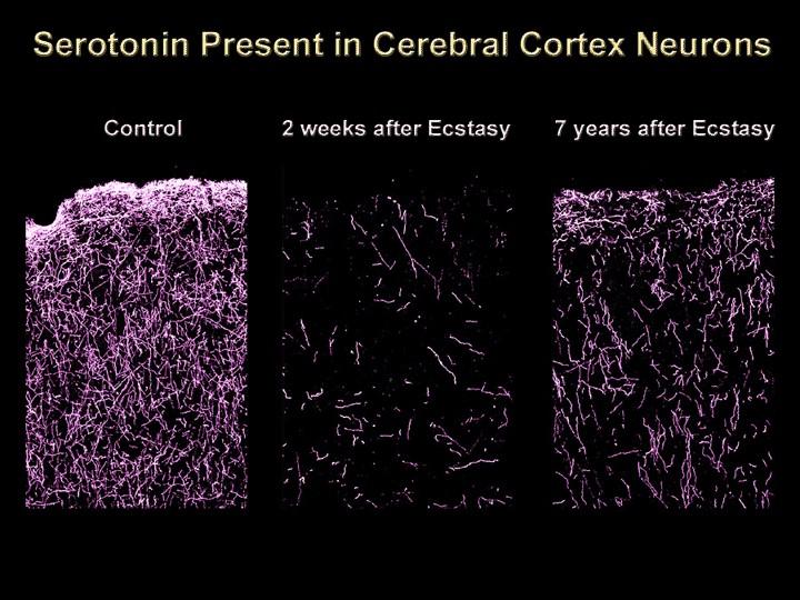 Ecstasy - langtidseffekt Sections taken from the neocortex of monkeys that were given Ecstasy