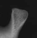 2. Sammenligning af caput mandibulae klinisk og i transfaryngeal projektion. Forstørrelse 1:1. A: Caput fotograferet i forlængelse af den transverselle akse. Klinisk dorsoventral dimension 8,8 mm.