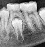 Et andet spørgsmål, der ofte rejses, er spørgsmålet om, hvor længe de primære tænder kan persistere i tandsæt med multiple agenesier? Her ser billedet anderledes ud.