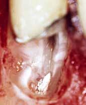 dels inflammationsceller (D) samt fragmenter af dentin (sort asterisk).