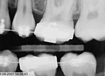 Multifaktorielt eksempel A B C Fig. 10. Efter ortodontisk indiceret fjernelse af præmolaren iværksættes ortodontisk behandling (A).