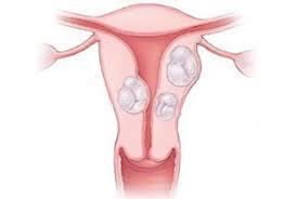 Forandringer i livmoderen kan i nogle tilfælde gøre det nødvendigt at fjerne livmoderen. Det er mest hensigtsmæssigt samtidig at fjerne æggelederne, da de er en integreret del af livmoderen.