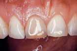 således også årsagen til, at tænderne er mere modtagelige over for farvestoffer lige efter, der er bleget.