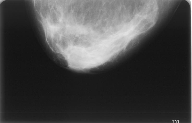 Mammografi, kvinde 40 år