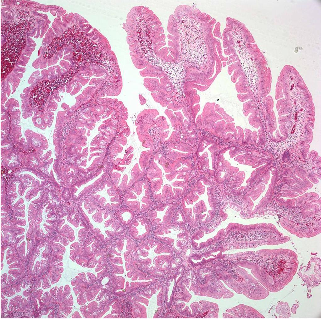 TSA Figure 3.Traditional serrated adenoma. This polyp is composed of villiform projections of hypereosinophilic cells with small oval-shaped nuclei oriented basally along the basement membrane.