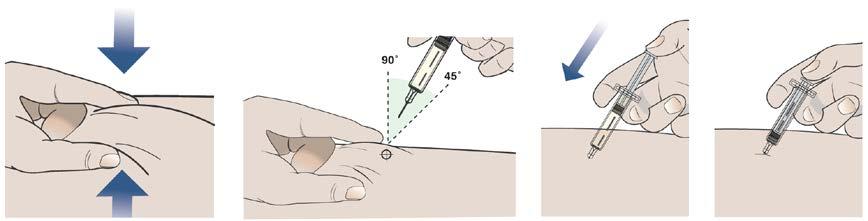 b) Injicer ved at følge de 4 nedenstående trin. 1. Tag fat om en hudfold på mindst 2,5 cm af den hud, som du har renset forinden. 2. Indstik kanylen i hudfolden med en vinkel på 45 til 90. 3.