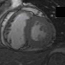 Figure 2 : In the initial evaluation a large number of studies reported wall thinning and fat infiltration on the CMR study that was not subsequently confirmed at the more experienced referral centre
