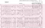Clinical Vignette: Irregularly Irregular Wide Complex Tachycardia 29 Figure 1 : Preexcited Atrial fibrillation with rapid ventricular response Figure 2 : Preexcited Atrial fibrillation with rapid