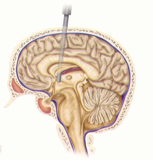 Kikkertoperation Ved en kikkertoperation (endoskopisk 3. ventrikulostomi) laver man et hul i bunden af 3. ventrikel (Figur 7).