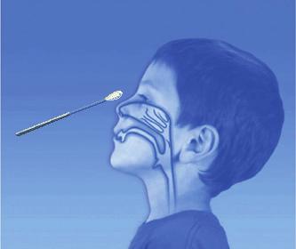 Indfør podepinden gennem et af patientens næsebor, så den når overfladen af den posteriore nasopharynx. 3. Drej podepinden hen over overfladen på den posteriore nasopharynx. 4.