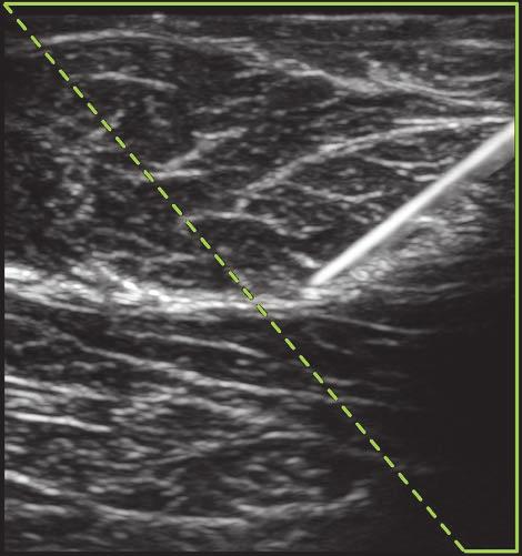 Visualisering af nåle ADVARSEL Sådan undgås forkert placering af nålen, når Needle Profiling er slået til: Verificer nålespidsens placering og bane ved hjælp af bevægelse og væskeinjektion.