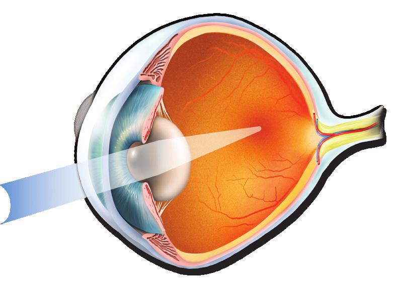 Billeddannelsen på nethinden Et normalt øje ser skarpt, hvis lyset fra den genstand, øjet betragter, samles præcist på nethinden i den gule plet (figur 1).