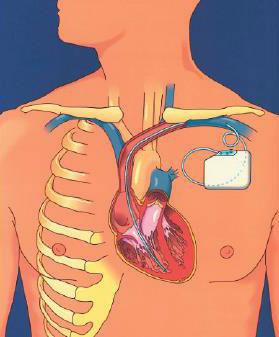 Almindelig ICD Har man haft anfald af livstruende, hurtig hjerterytme, ventrikulær takykardi (VT) eller ventrikelflimmer (VF), kan man indoperere en særligt avanceret pacemaker - en ICD.