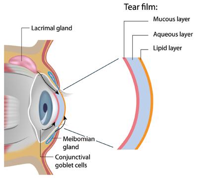 (DED) may lead to ocular surface discomfort, often described as feelings of dryness, burning, a sandy/gritty sensation, or itchiness and thus causes ocular discomfort for many, many people.