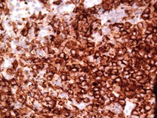 Immunhistokemisk farvning viste histiocytære celler, der var kraftigt reagerende for CD68, og endnu kraftigere reagerende for S-100 og CD1A, forenelige med langerhanske celler.